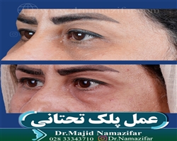عمل پلک