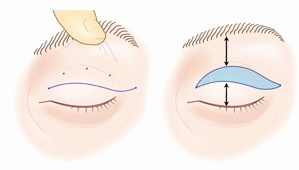 عمل جراحی زیبایی پلک (بلفاروپلاستی) یا  Blepharoplasty