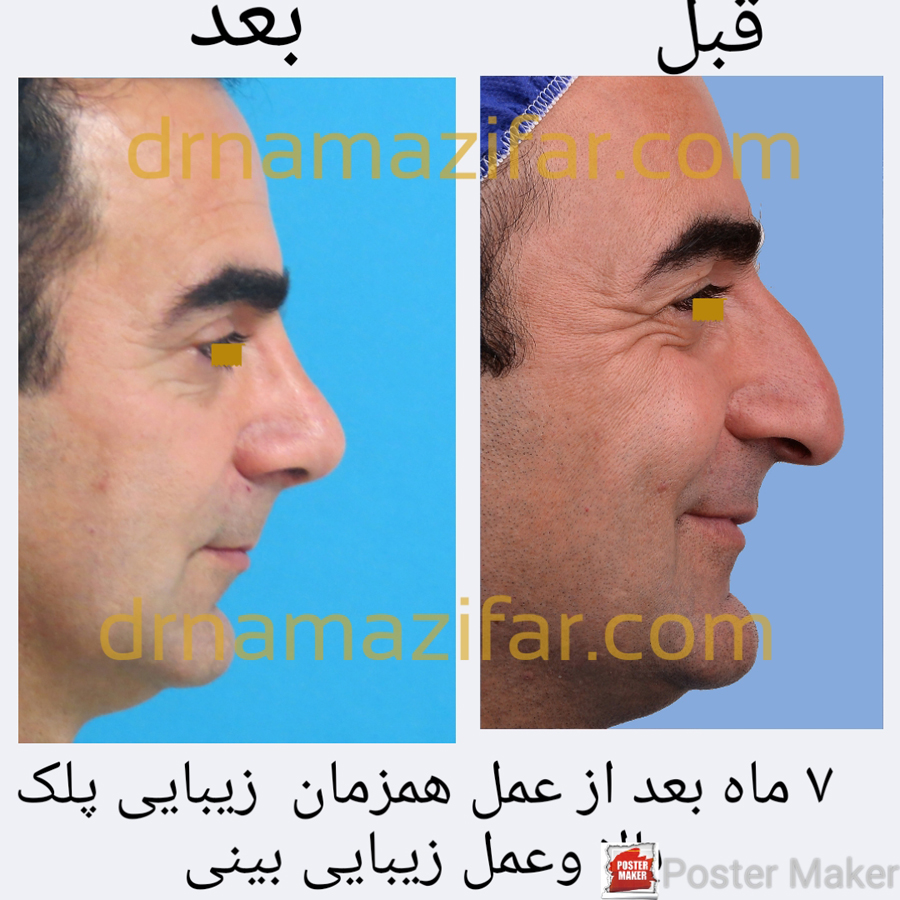 عمل جراحی  پلک و عمل زیبایی بینی به صورت همزمان