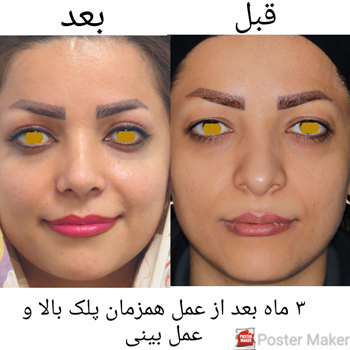 عمل جراحی زیبایی پلک (بلفاروپلاستی) و عمل زیبایی بینی به صورت همزمان
