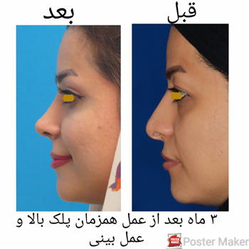 عمل جراحی زیبایی پلک (بلفاروپلاستی) و عمل زیبایی بینی به صورت همزمان: