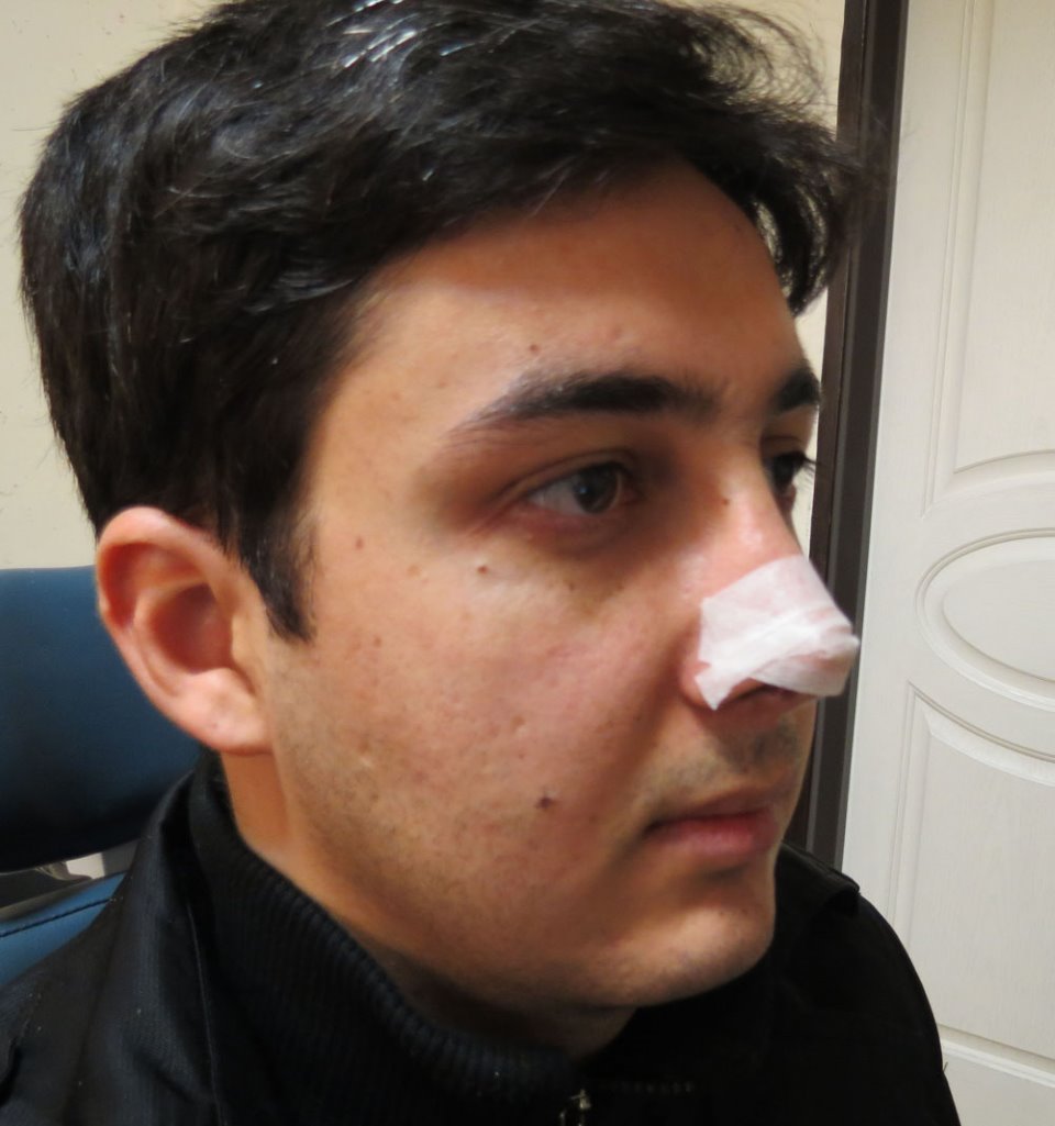 نحوه چسب زدن بینی بعد از عمل بینی