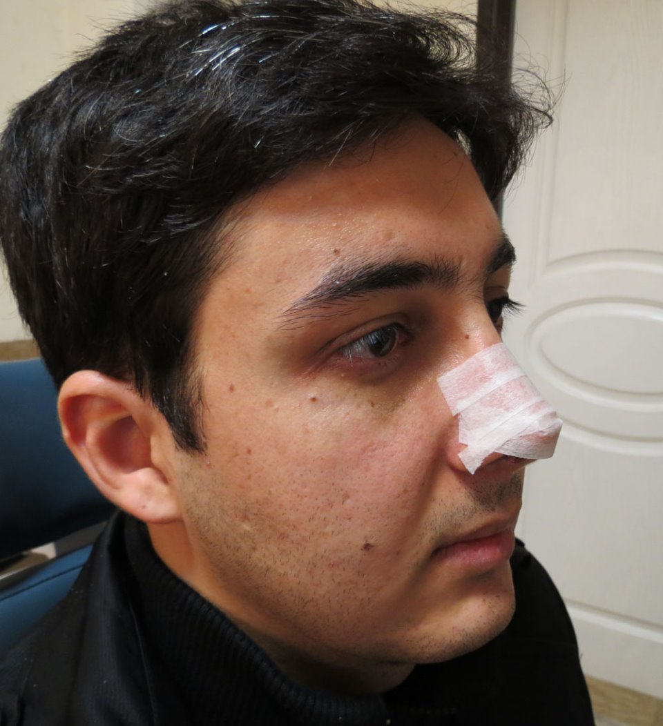چسب زدن بینی بعد از عمل بینی