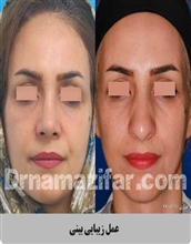 بلفاروپلاستی