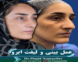 لیفت ابرو
