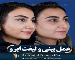 لیفت ابرو