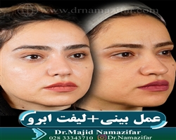 لیفت ابرو