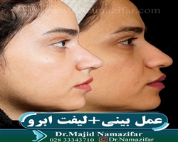 لیفت ابرو