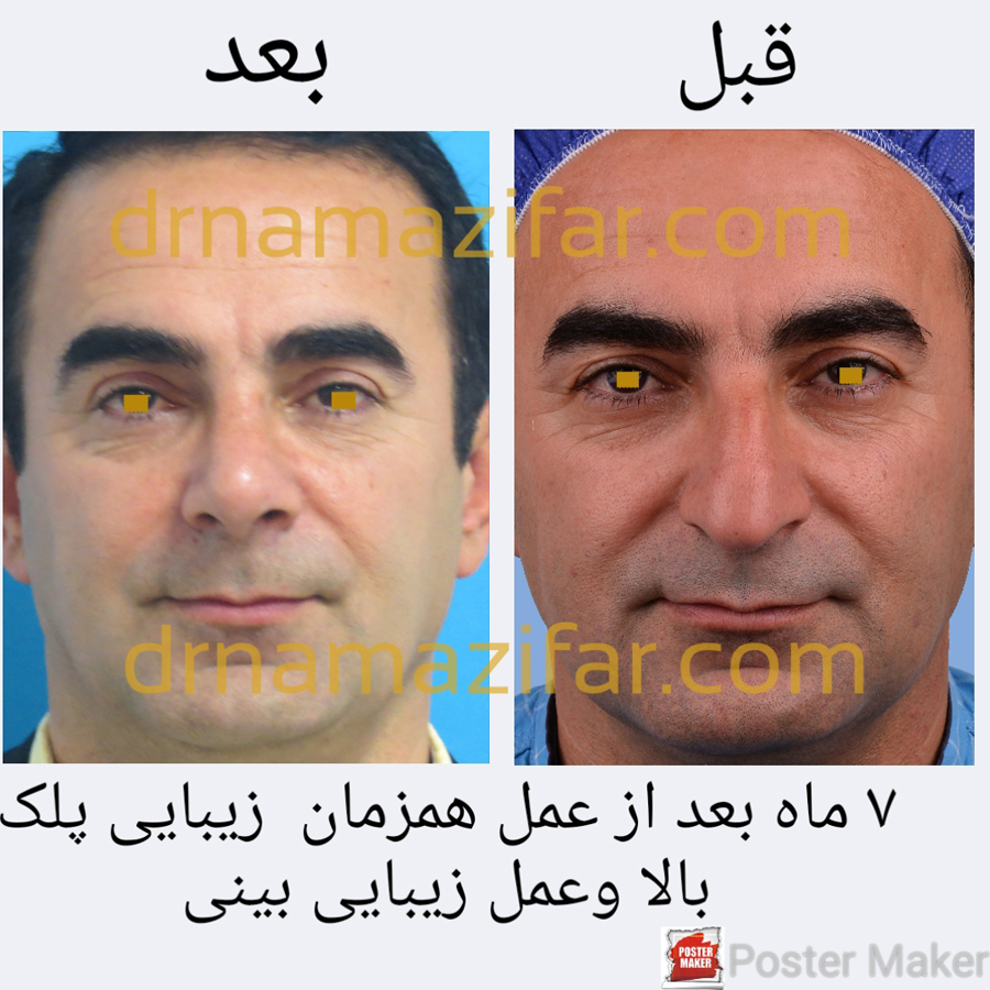 عمل جراحی پلک و عمل زیبایی بینی به صورت همزمان