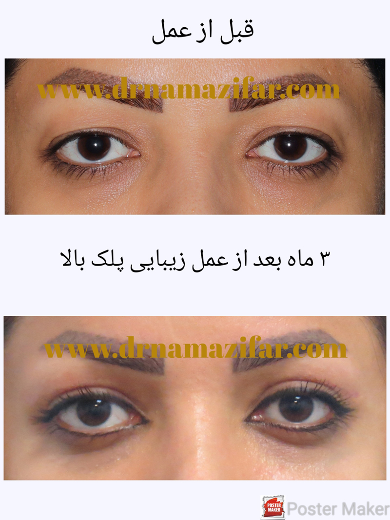 عمل جراحی زیبایی پلک (بلفاروپلاستی) یا  Blepharoplasty