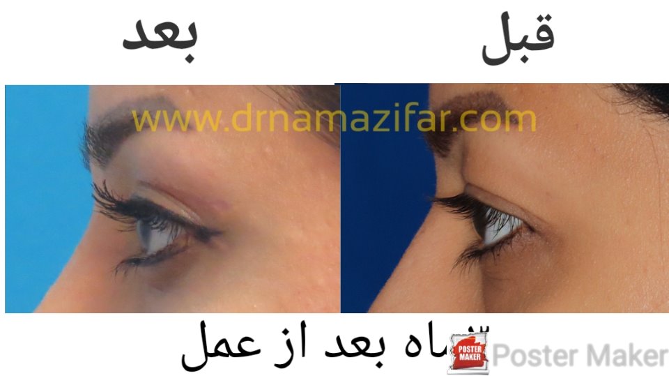 عمل جراحی زیبایی پلک (بلفاروپلاستی) یا  Blepharoplasty