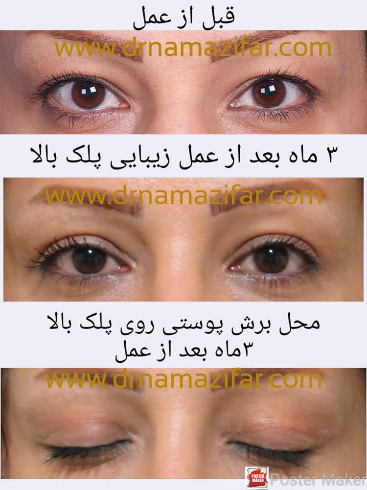 عمل جراحی زیبایی پلک (بلفاروپلاستی) یا  Blepharoplasty