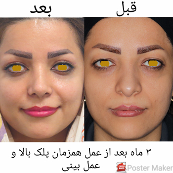 عمل جراحی زیبایی پلک (بلفاروپلاستی) و عمل زیبایی بینی به صورت همزمان: عمل جراحی زیبایی پلک (بلفاروپلاستی) و عمل زیبایی بینی به صورت همزمان