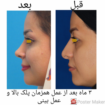 عمل جراحی زیبایی پلک (بلفاروپلاستی) و عمل زیبایی بینی به صورت همزمان: عمل جراحی زیبایی پلک (بلفاروپلاستی) و عمل زیبایی بینی به صورت همزمان: