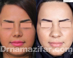 عمل بینی گوشتی توسط بهترین جراح بینی گوشتی